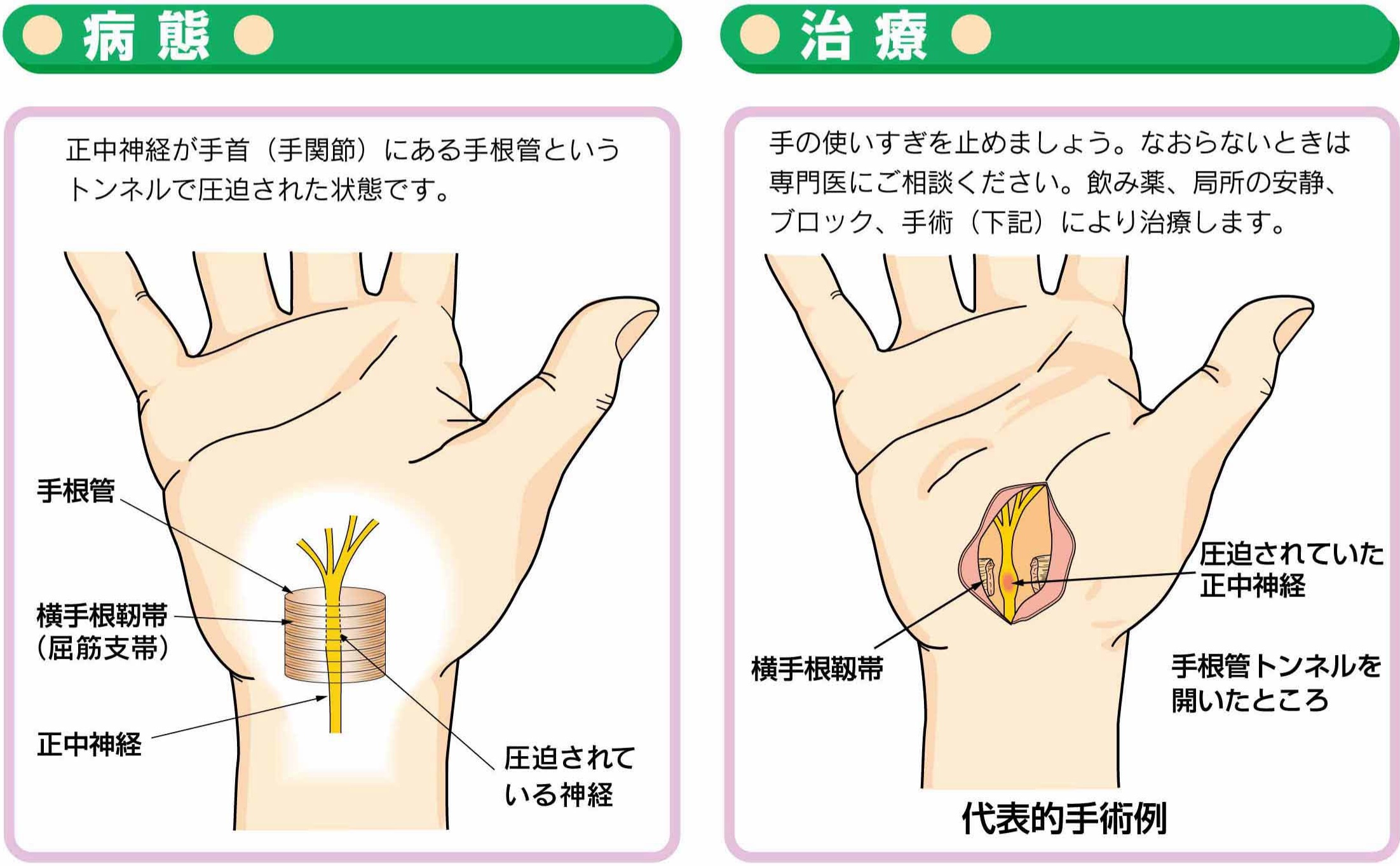 手のひら 親指 の 付け根 ふくらみ 痛い