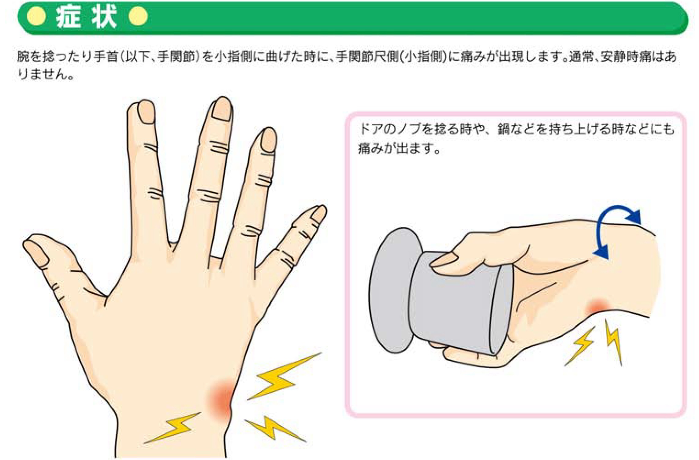 手関節tfcc損傷 お知らせ 溝口病院 救急指定病院 福岡