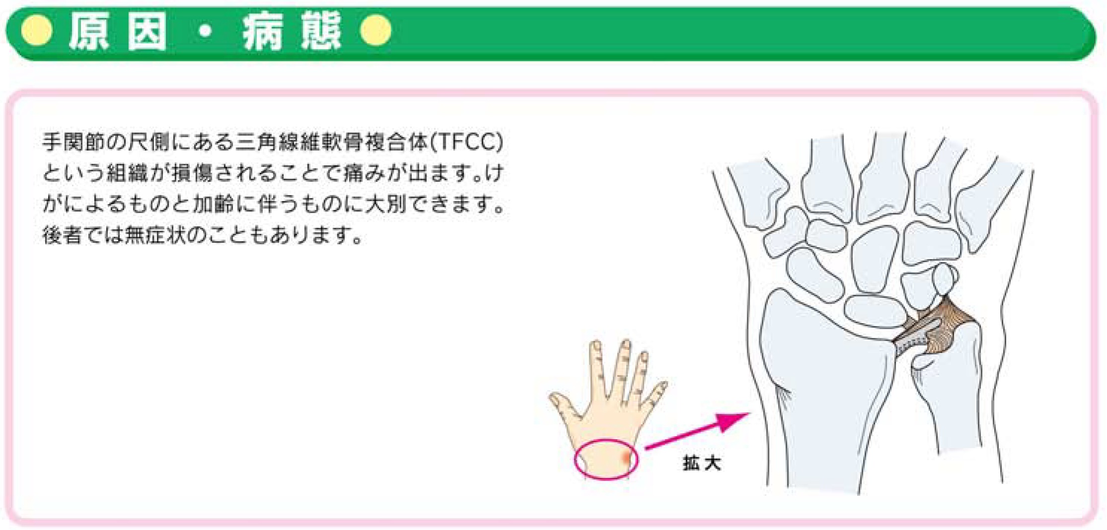 手関節tfcc損傷 お知らせ 溝口病院 救急指定病院 福岡