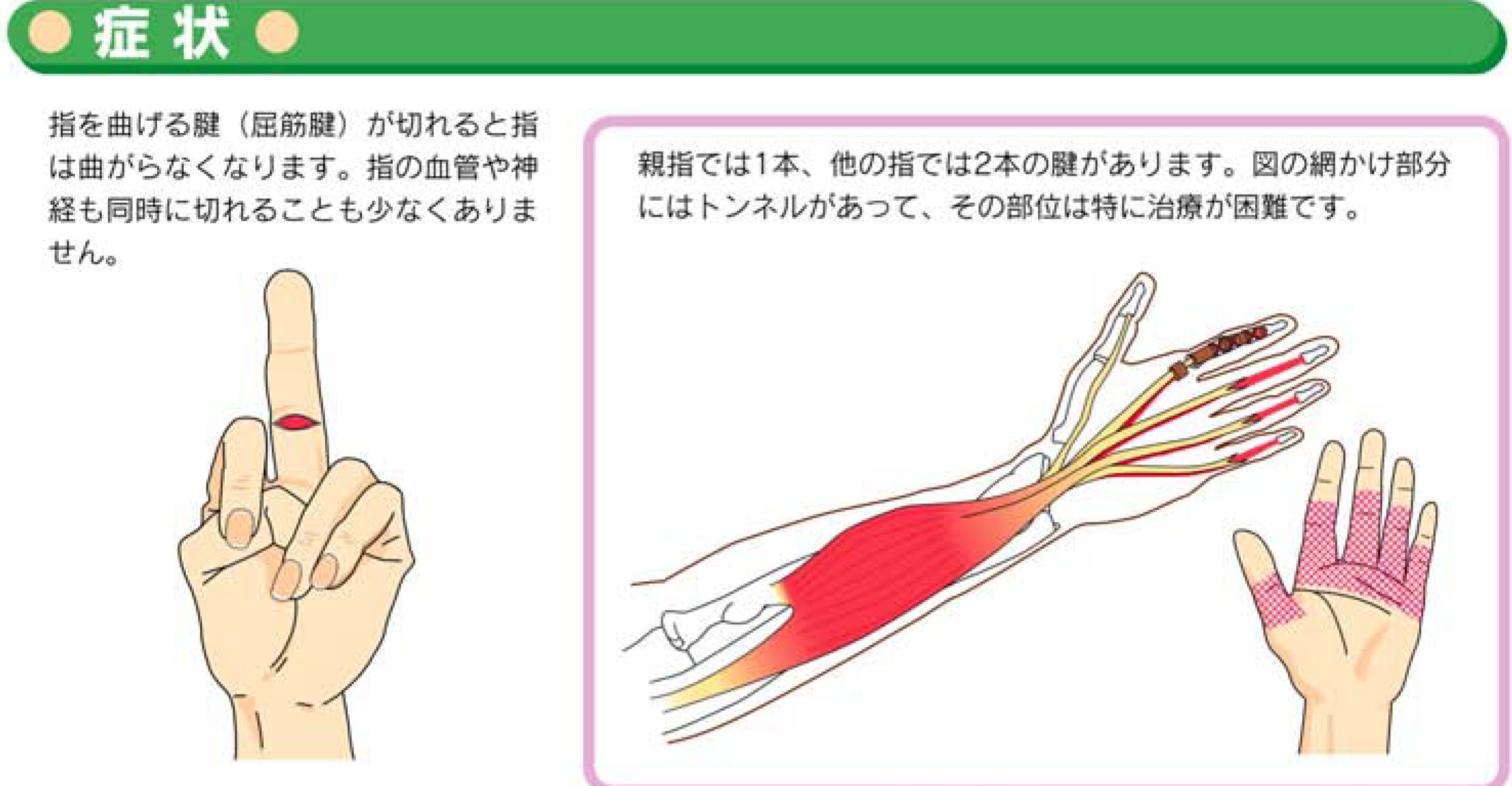 手指の屈筋腱損傷 お知らせ 溝口病院 救急指定病院 福岡