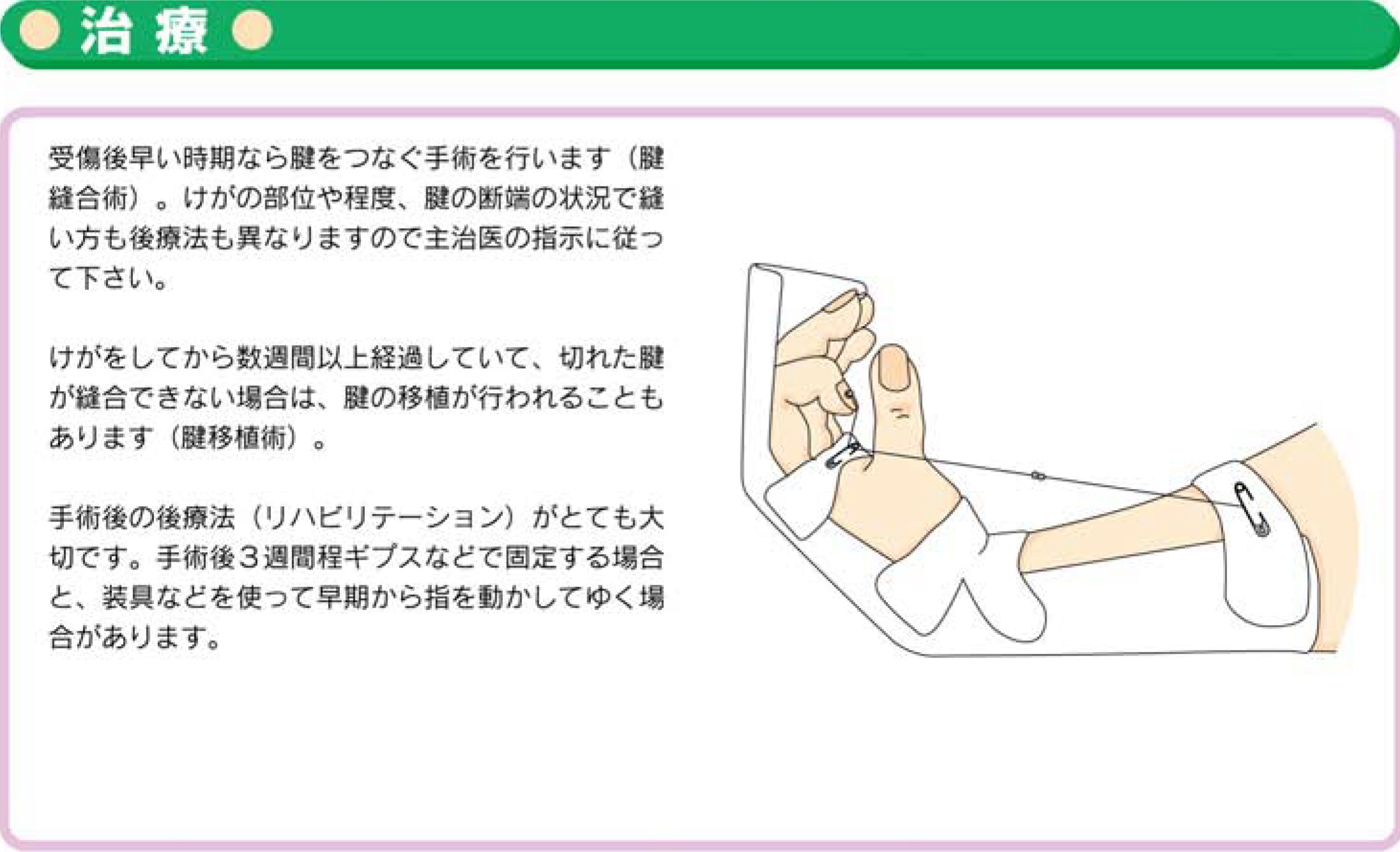 手指の屈筋腱損傷 お知らせ 溝口病院 救急指定病院 福岡